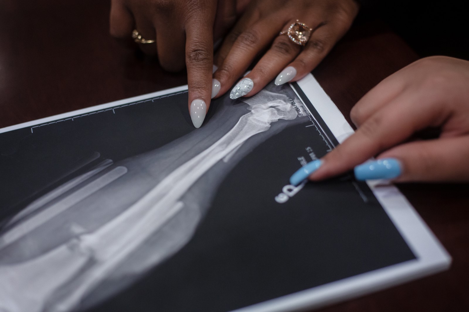 A lower leg X-ray of an injury victim